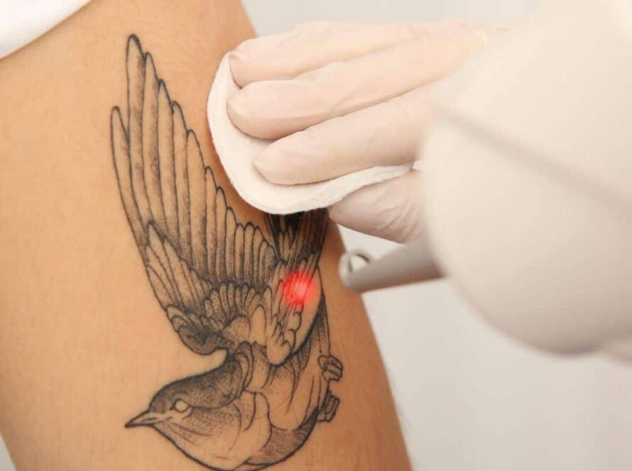 Le détatouage laser : le meilleur moyen d'enlever un tatouage