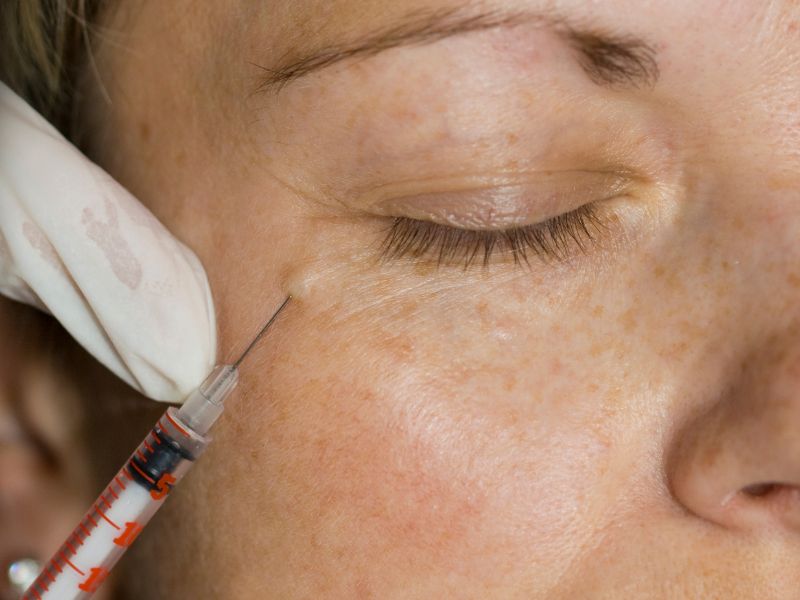 acide hyaluronique vs botox
