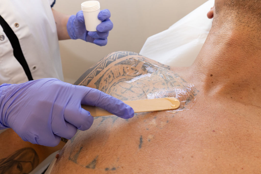 Détatouage laser
